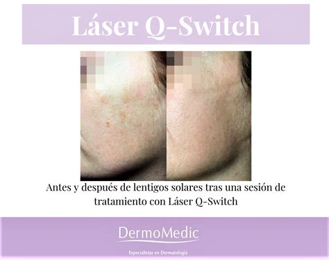 Quieres Eliminar Tus Manchas De La Piel Clinica Dermomedic