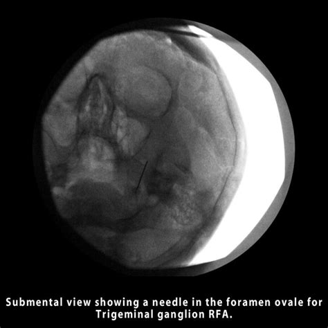 Trigeminal Ganglion Blockrfa Samer Narouze Md Phd