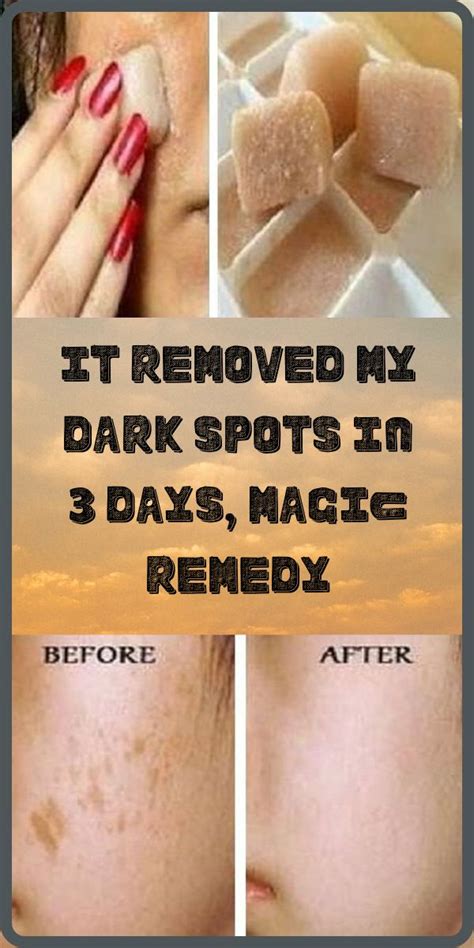 I’m Shocked It Removed My Dark Spots In 3 Days Magic Remedy Remedies Dark Spots Beauty Remedies