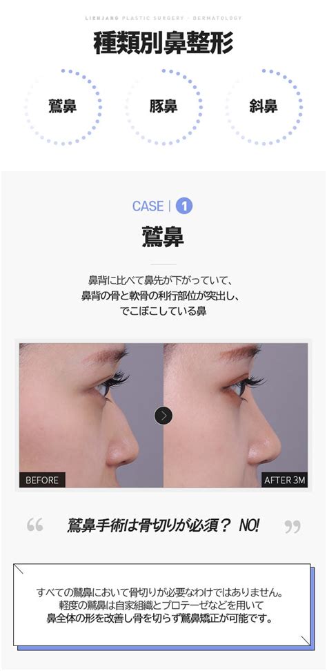どんな鼻の形でも問題ない「種類別鼻整形」 韓国リエンジャン美容外科