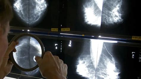 Mammograms Recommended Starting At 40 Amid Rising Younger Breast Cancer