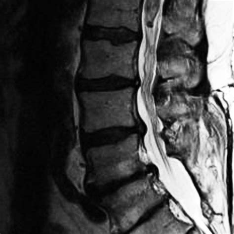 Sagittal Contrast Enhanced T1 Weighted Magnetic Resonance Image