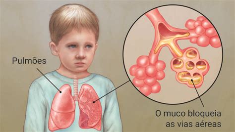 Fibrose Cística Causas Sintomas E Tratamento