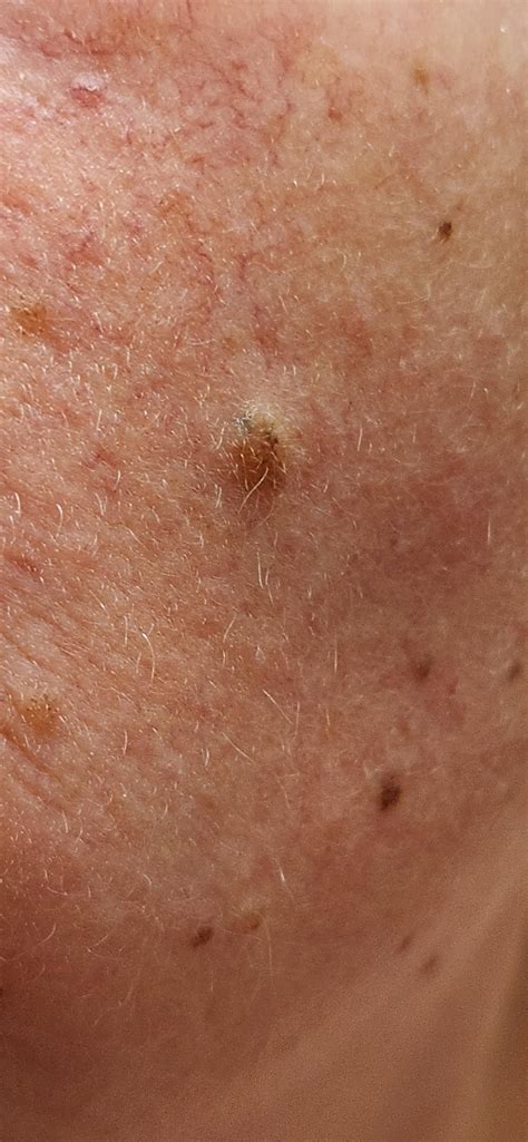 Cancerous Mole On Face Rdermatology