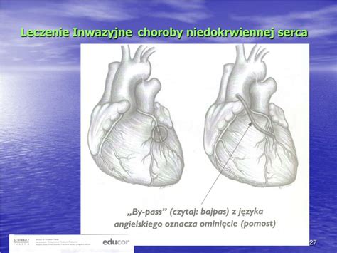 PPT Choroba Niedokrwienna Serca PowerPoint Presentation Free