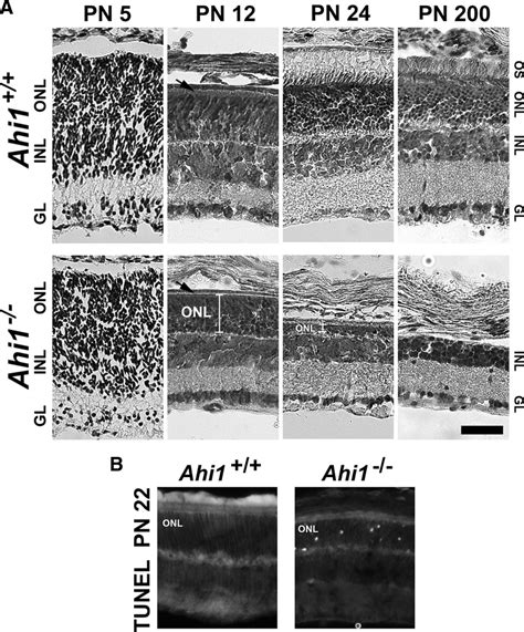 Retinal Degeneration In The Photoreceptors Outer Nuclear Layer Of