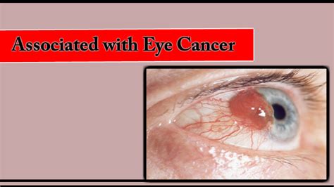 Understand the Risk Factors Associated with Eye Cancer