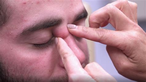 C Mo Quitarte Una Espinilla O Grano De Forma Correcta Espinillas