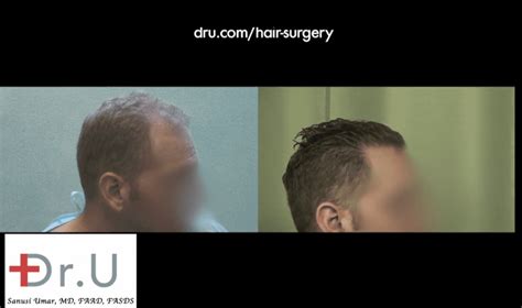 Dr U Hair Clinic Patient Results Album By Graft Count 2000 3999 Grafts