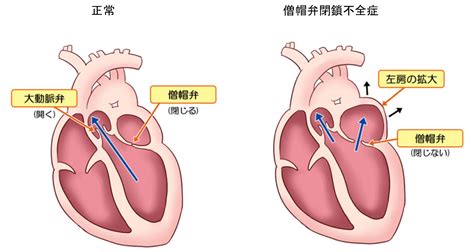 僧帽弁閉鎖不全症に対する低侵襲カテーテル治療：mitraclip Topics 聖マリアンナ医科大学 循環器内科