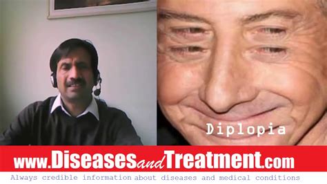 26 Diplopia Double Vision Causes Diagnosis Symptoms Treatment