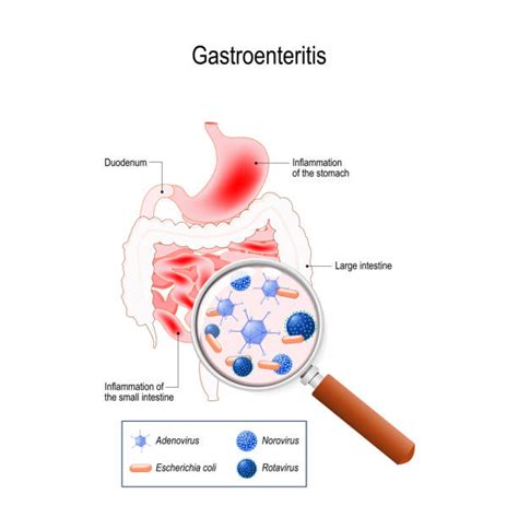 Gastroenteritis Illustrations Royalty Free Vector Graphics And Clip Art Istock