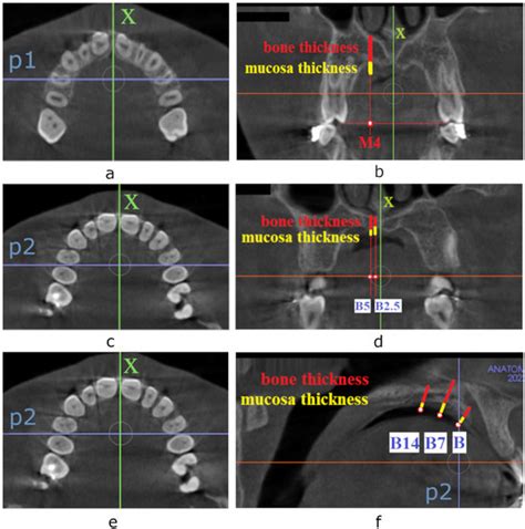 Diagnostics Free Full Text Evaluation Of Palatal Bone Thickness At