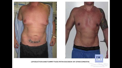 Plastic Surgery Gone Right Tummy Tuck West Palm Beach Palm Beach