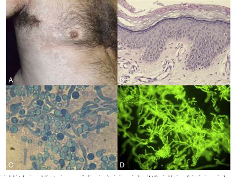 Figure 1 From Skin Diseases Associated With Malassezia Yeasts Facts