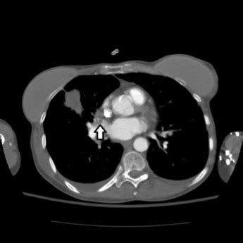 Year Old Woman With Acute Onset Cough Chest Tightness And