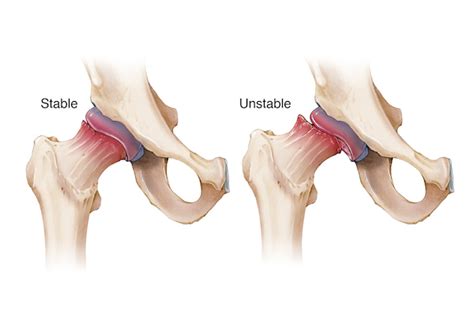 Slipped capital femoral epiphysis