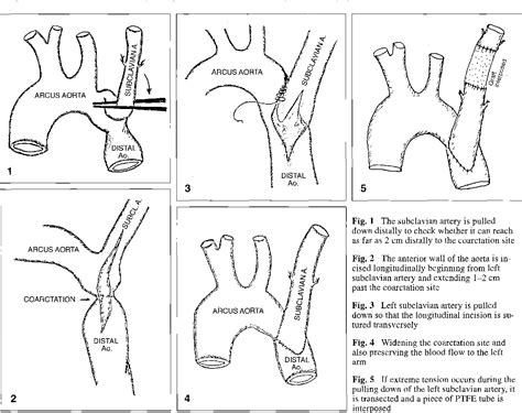 Early And Moderate Long Term Results Of A New Surgical Technique For Repair Of Aortic