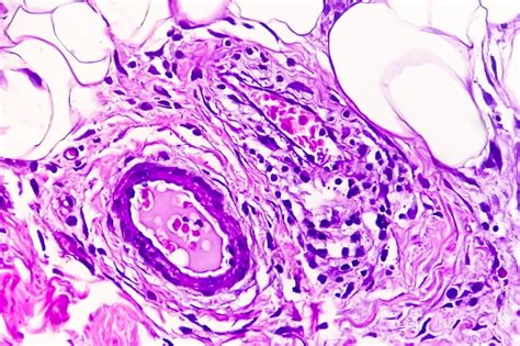 Premium Photo | Photomicrograph of granulomatous tissue histology showing foreign body granuloma