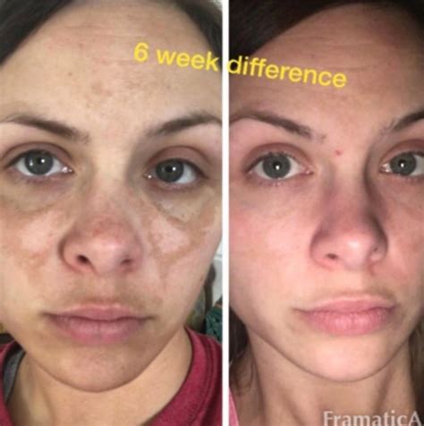 Admire My Skin Dark Spot Serum Has Mind Blowing Results Us Weekly