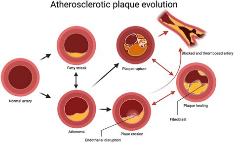 Illustrates The Progression Of Atherosclerosis In Cvd