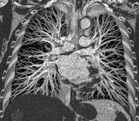 Spiral Computed Tomography Is The First Line Chest Imaging Test For