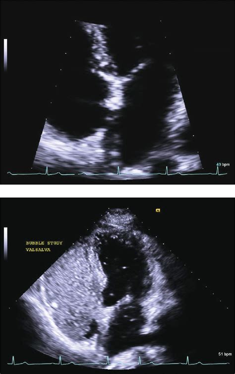 Echocardiographic Assessment Of The Patient With Stroke Or Tia A