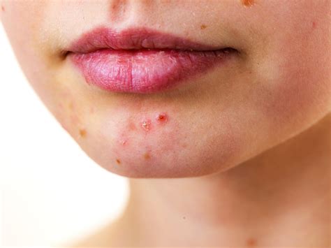 Perioral Dermatitis Face