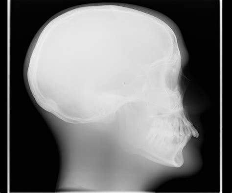 Normal Kvp And Low Mas Radiograph Hansamu Mas