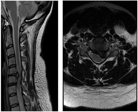 Clinical And Radiological Outcome Of Disc Arthroplasty For The Treatment Of Cervical Spondylotic