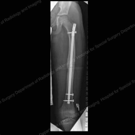 Femur Fracture Anatomy