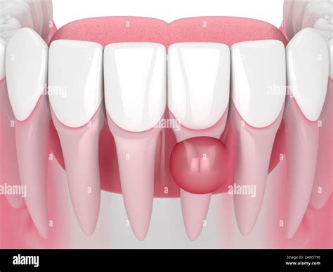 D Render Of Jaw With Cyst On Teeth Root Over White Background Dental