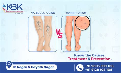 Varicose Veins Vs Spider Veins Causes Treatment And Prevention