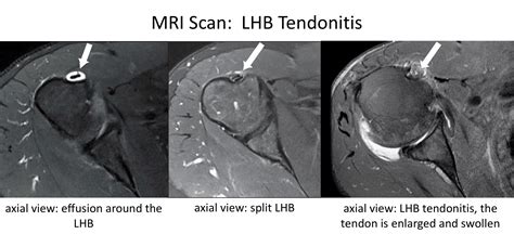 Fig 6 Mri Tendonitis Cambridge Shoulder