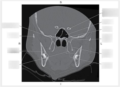 Coronal CT of Sphenoid Bone Diagram | Quizlet