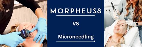 Morpheus8 Vs Microneedling Allure Rejuvenation Center