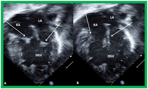 Double Inlet Left Ventricle Pmc