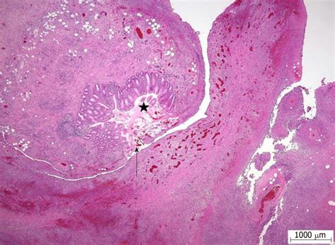 Acute Appendicitis Histology