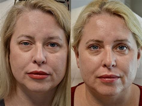 Ptosis Repair Surgery Before And After Photos Fresh Face Eye