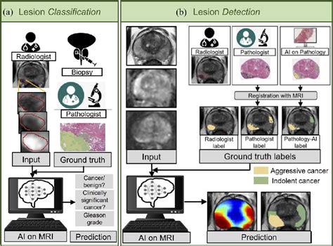 Figure From A Review Of Artificial Intelligence In Prostate Cancer