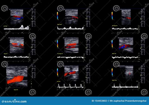 Ultrasound Doppler For Finding Deep Vein Thrombosis Royalty-Free Stock Photography ...