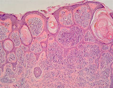 Dermatopatologia Para Iniciantes Nevos MelanocÍticos Usuais