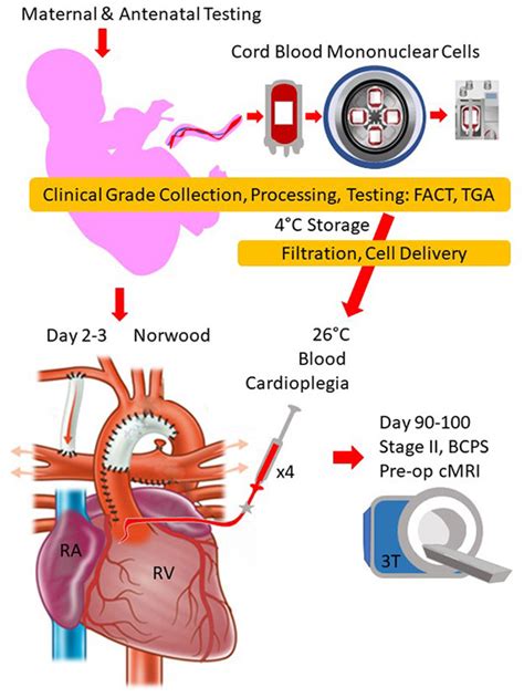 Safety And Feasibility Of Adjunct Autologous Cord Blood Stem Cell