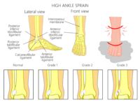 High Ankle Sprain Rehab Propel Physiotherapy