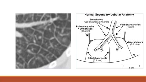 The Secondary Pulmonary Lobule