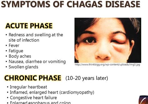 Chagas Diseasewhat Is Chagas Diseasechagas Illness Transmittedwhat