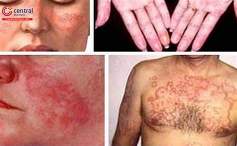 Nguyên Nhân Chẩn đoán Và điều Trị Bệnh Lupus Ban đỏ Hệ Thống