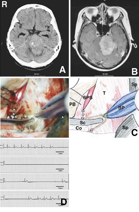 Case A B Computed Tomography Scan A And T Weighted Magnetic