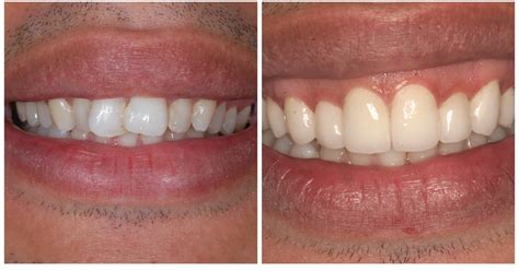 Porcelain Veneers NYC Porcelain Veneers In Manhattan 209 NYC Dental