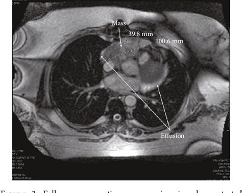 Figure From A Rare Cardiac Cavernous Hemangioma Treated With